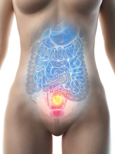 Рак толстой кишки в женском теле, концептуальная компьютерная иллюстрация
. — стоковое фото