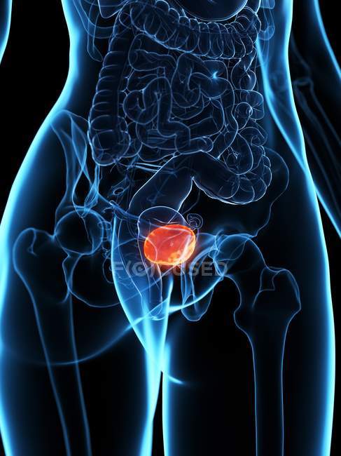 Хворого сечового міхура в прозорій моделі жіночого тіла, концептуальна ілюстрація . — стокове фото