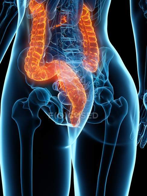 Female body with diseased colon, digital illustration. — Stock Photo