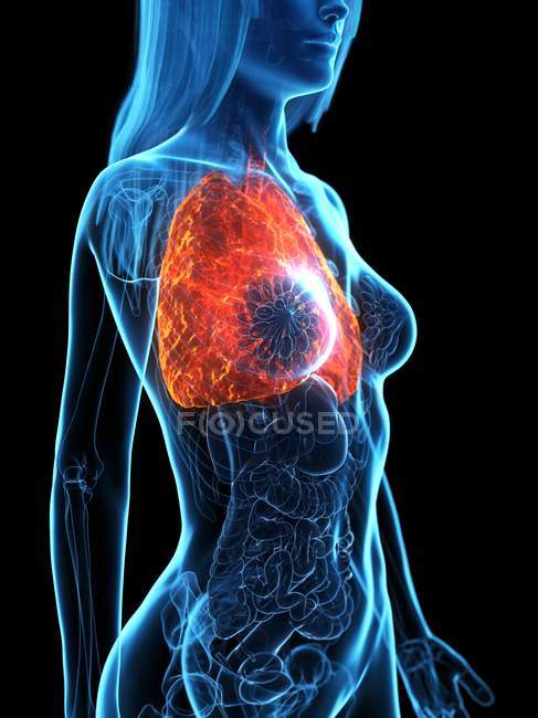 Хворі легені в прозорому жіночому тілі на чорному тлі, комп'ютерна ілюстрація . — стокове фото