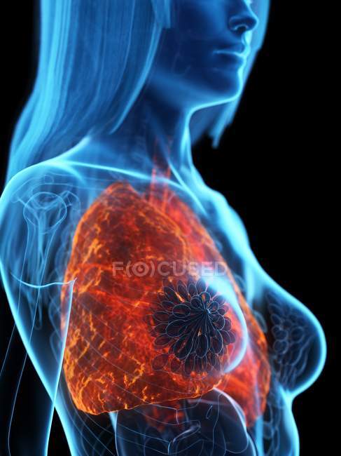 Pulmones enfermos en cuerpo femenino transparente sobre fondo negro, ilustración por computadora . - foto de stock