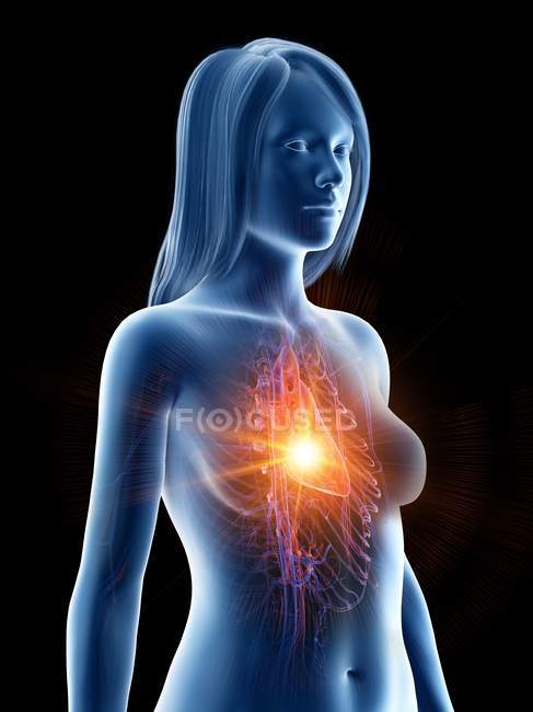 Cuerpo femenino con ataque cardíaco, ilustración digital conceptual . - foto de stock