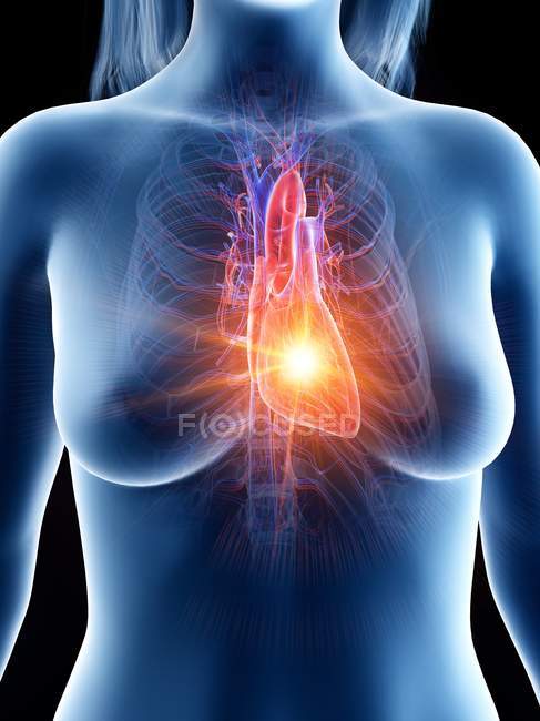 Cuerpo femenino con ataque cardíaco, ilustración digital conceptual
. - foto de stock