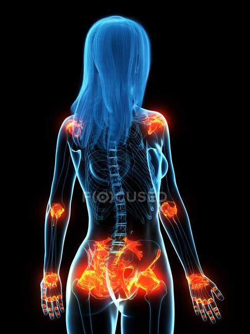 Inflamed ligaments in female body, conceptual computer illustration. — Stock Photo