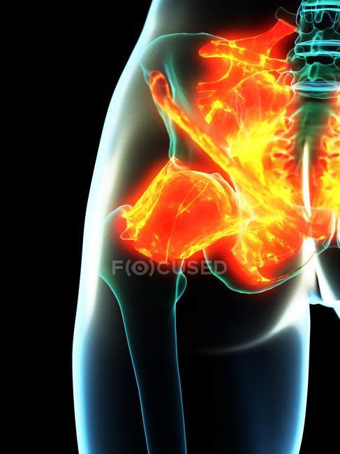 Ligaments enflammés dans les hanches humaines, illustration conceptuelle par ordinateur . — Photo de stock