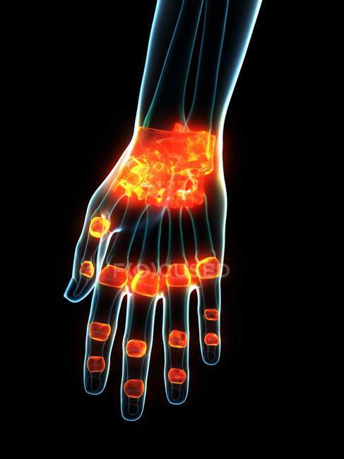 Ligamentos inflamados en la mano humana, ilustración conceptual por ordenador . - foto de stock
