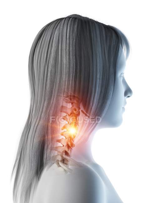 Silueta de mujer con dolor de cuello brillante, ilustración conceptual por computadora
. - foto de stock