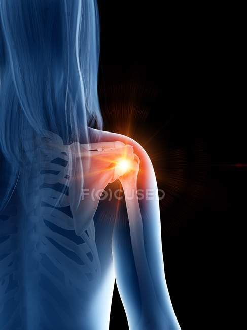 Silhouette of woman with glowing shoulder pain, conceptual computer illustration. — Stock Photo