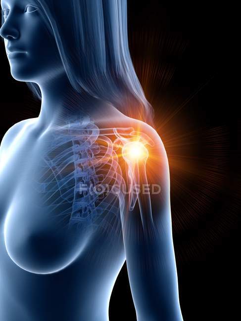 Силуэт женщины со светящимися болями в плече, концептуальная компьютерная иллюстрация . — стоковое фото