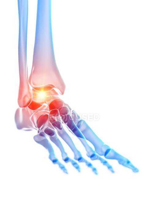 Acute pain in ankle of human foot, digital illustration. — Stock Photo