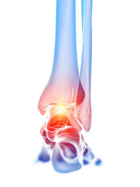 Гострий біль в щиколотці людської ноги, цифрова ілюстрація . — стокове фото