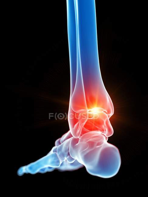 Dor aguda no tornozelo do pé humano, ilustração digital . — Fotografia de Stock