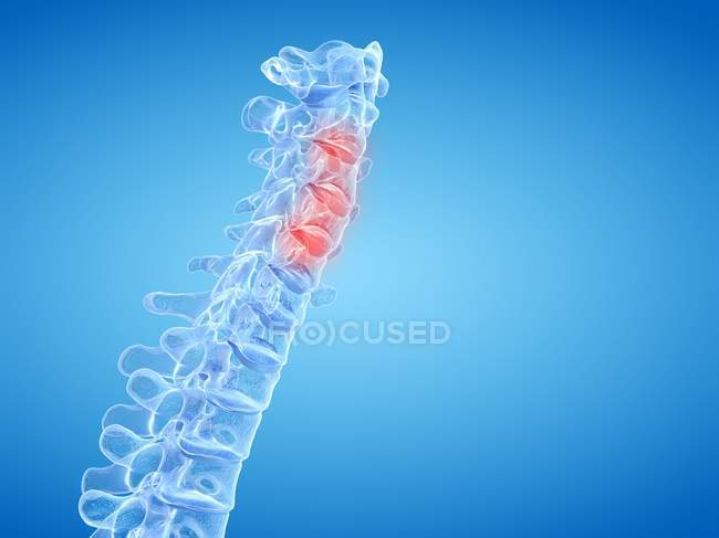 Espina dorsal humana que muestra dolor de espalda, ilustración conceptual por computadora . - foto de stock