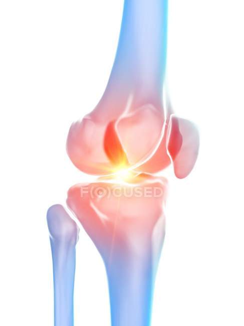 Human anatomy of knee pain, conceptual computer illustration. — Stock Photo