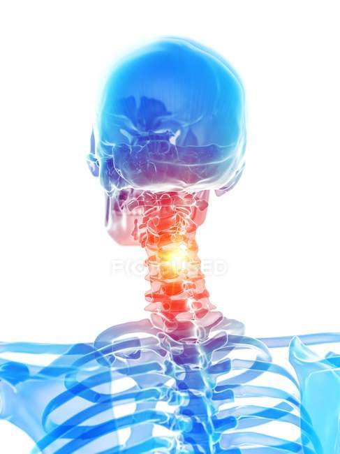 Esqueleto humano com dor no pescoço, ilustração conceitual do computador . — Fotografia de Stock