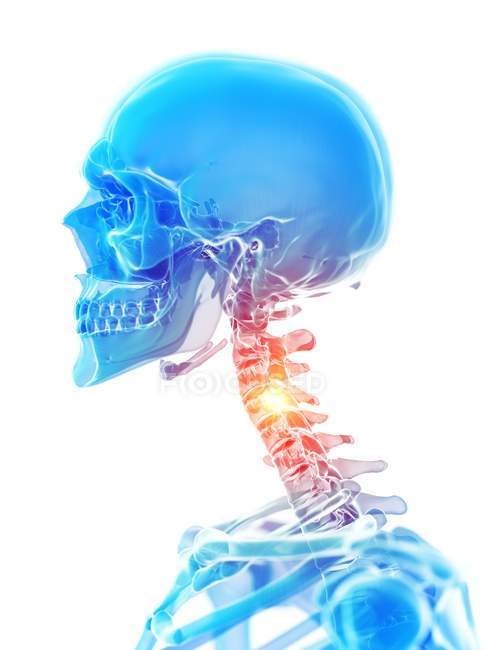 Human skeleton with neck pain, conceptual computer illustration. — Stock Photo