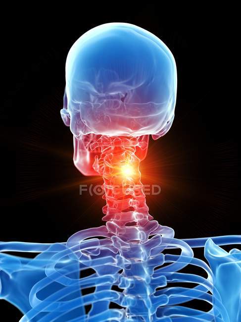 Human skeleton with neck pain, conceptual computer illustration. — Stock Photo