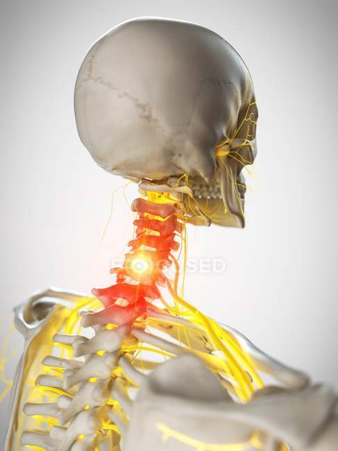 Людський скелет з болем в шиї, концептуальна комп'ютерна ілюстрація . — стокове фото