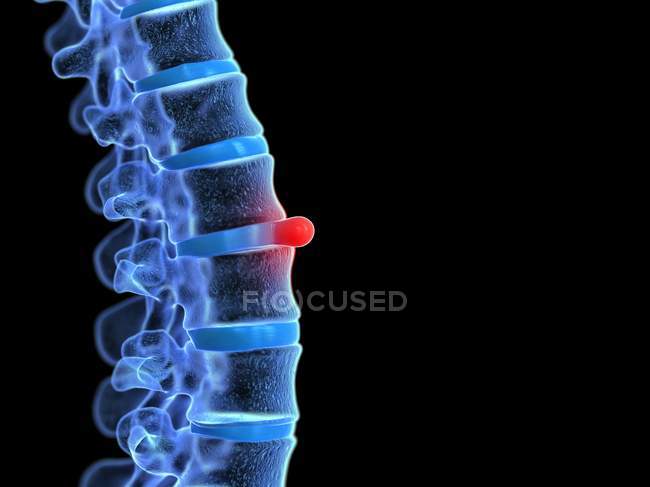 Disco vertebrale prolasso, illustrazione digitale . — Foto stock