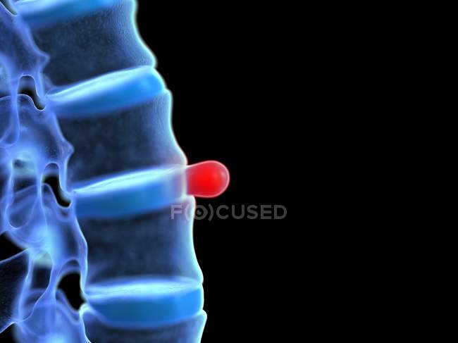 Prolapsed spinal disc, digital illustration. — Stock Photo