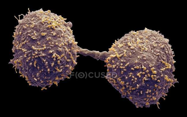 Dividir las células cancerosas de la glándula prostática, micrografía electrónica de exploración coloreada
. - foto de stock
