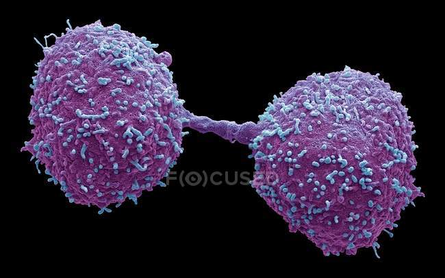 Diviser les cellules cancéreuses de la prostate, micrographie électronique à balayage coloré
. — Photo de stock