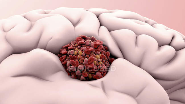 Células cancerosas en el cerebro humano, ilustración digital . - foto de stock