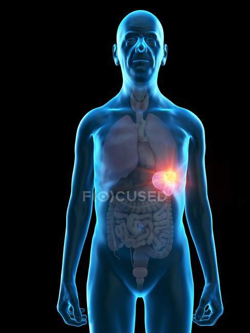 Illustration numérique de l'anatomie de l'homme âgé montrant une tumeur de la rate . — Photo de stock