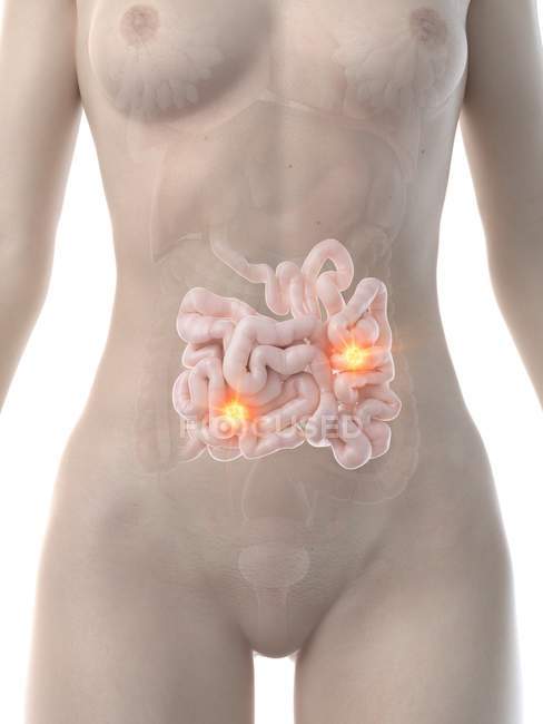 Cuerpo femenino con cáncer de intestino delgado, ilustración conceptual por computadora
. - foto de stock