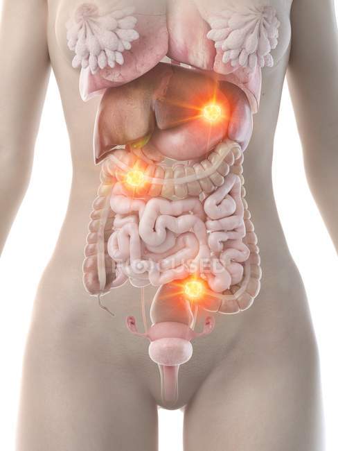 Cuerpo femenino con metástasis de cáncer, ilustración conceptual por computadora
. - foto de stock