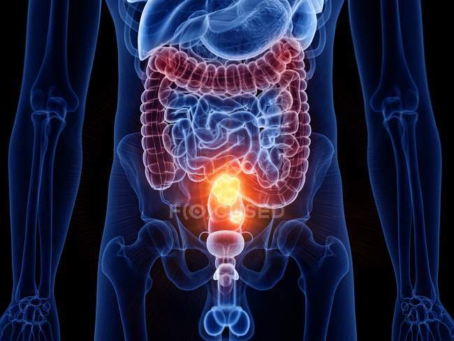 Corpo maschile astratto con cancro al colon, illustrazione al computer . — Foto stock