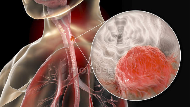 Cancro esofageo, illustrazione digitale composita con corpo umano e cellule tumorali . — Foto stock