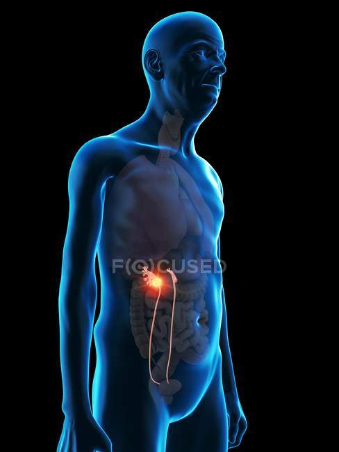 Digital illustration of senior man anatomy showing ureters tumour. — Stock Photo