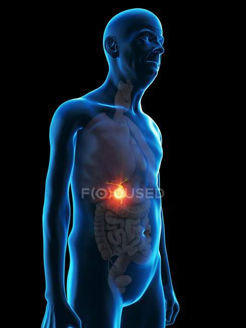Ilustração digital da anatomia do homem sênior mostrando tumor da vesícula biliar . — Fotografia de Stock