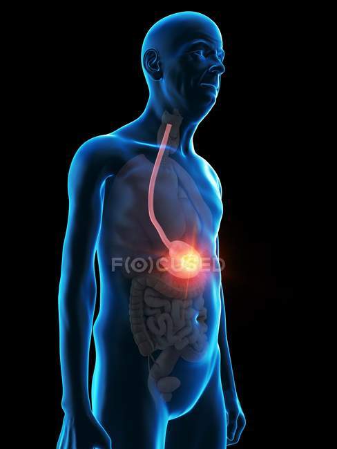 Ilustración digital de la anatomía del hombre mayor que muestra tumor estomacal . - foto de stock