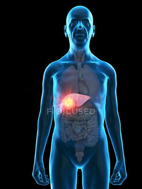 Illustration numérique de l'anatomie d'un homme âgé montrant une tumeur du foie
. — Photo de stock