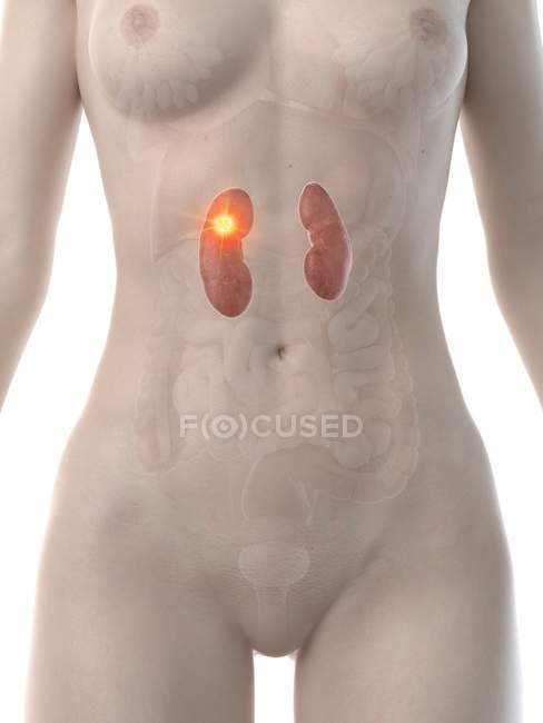 Жіноче тіло з раком нирок, комп'ютерна ілюстрація. — стокове фото
