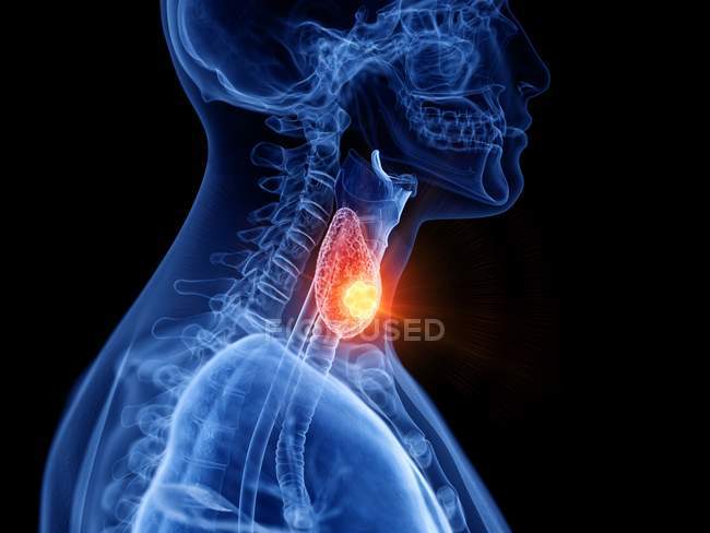 Corpo masculino transparente abstrato com câncer de tireoide brilhante, ilustração digital . — Fotografia de Stock