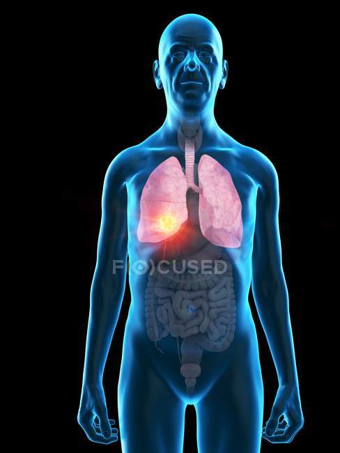 Цифрова ілюстрація анатомії чоловіка похилого віку, що показує пухлину легенів.. — стокове фото
