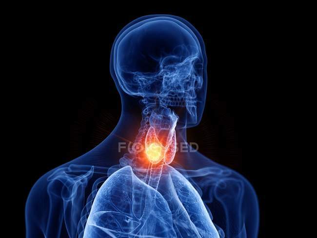 Abstrakter transparenter Männerkörper mit glühendem Schilddrüsenkrebs, digitale Illustration. — Stockfoto