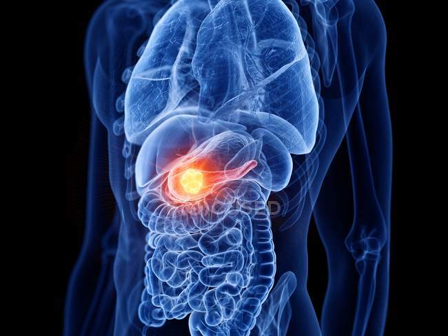 Pancreas cancer in male body, computer illustration. — Stock Photo