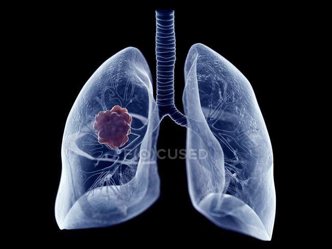 Tumor pulmonar, ilustración por ordenador - foto de stock