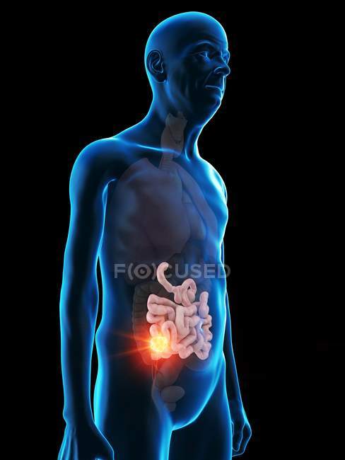 Digital illustration of senior man anatomy showing small intestine tumour. — Stock Photo