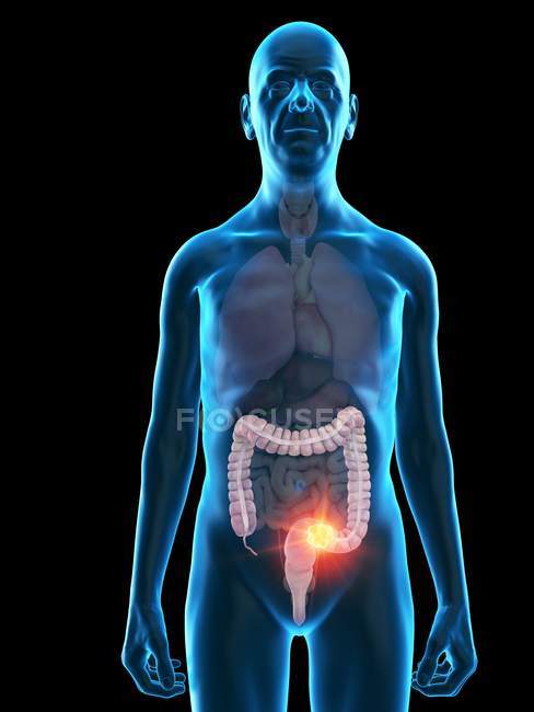 Ilustración digital de la anatomía del hombre mayor que muestra el tumor de colon
. - foto de stock