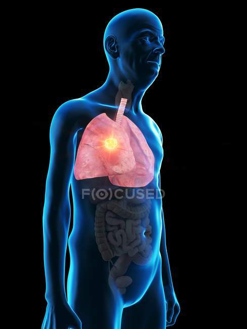 Ilustración digital de la anatomía del hombre mayor que muestra el tumor pulmonar
. - foto de stock