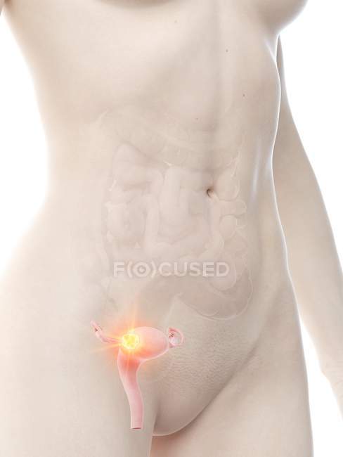 Anatomischer weiblicher Körper mit Gebärmutterkrebs, konzeptionelle digitale Illustration. — Stockfoto