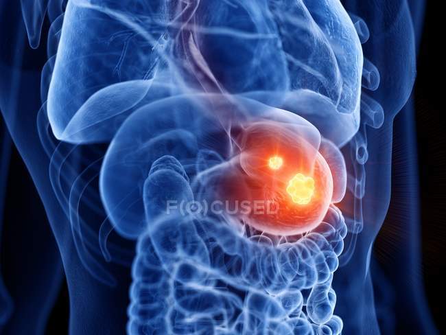 Astratto corpo maschile trasparente con cancro allo stomaco incandescente, illustrazione digitale . — Foto stock