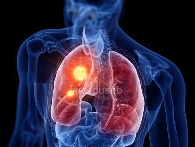 Абстрактний силует самця з раком легенів, цифровий приклад. — Stock Photo