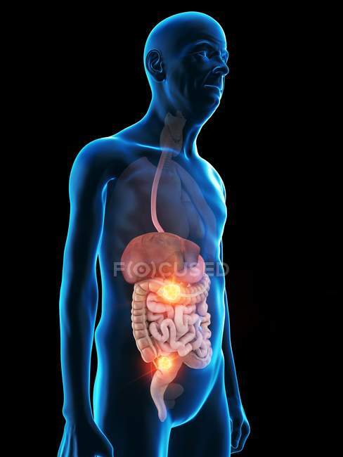 Цифрова ілюстрація анатомії чоловіка похилого віку, що показує пухлину травної системи.. — стокове фото