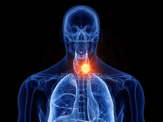 Corps masculin transparent abstrait avec cancer de la thyroïde éclatant, illustration numérique
. — Photo de stock